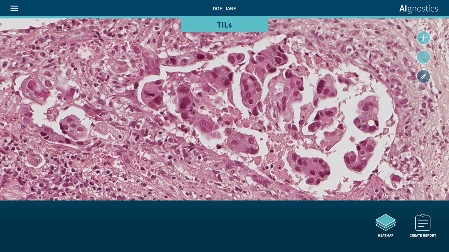 Breast Cancer Tissue Sample