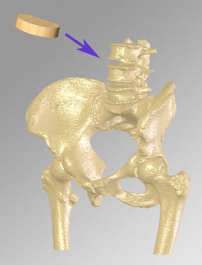 Monolith in Relation to Lumbar Spine