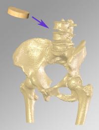 Monolith in Relation to Lumbar Spine