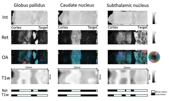 PS-OCT provides higher resolution and contrast images than MRI, as demonstrated in three common DBS targets: the subthalamic nucleus (right), the caudate nucleus (center), and the globus pallidus (left).