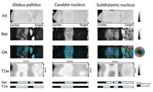 PS-OCT provides higher resolution and contrast images than MRI, as demonstrated in three common DBS targets: the subthalamic nucleus (right), the caudate nucleus (center), and the globus pallidus (left).