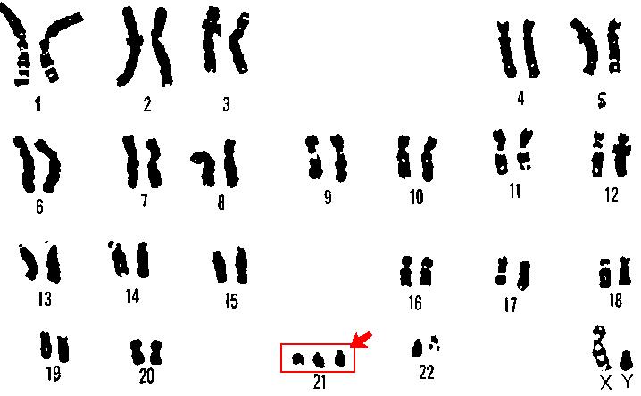 Same Gene Links Blood Sugar Problems in down Syndrome and Type 2 Diabetes