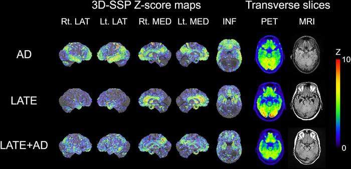 Imaging of individuals suspected of having Alzheimer.'s disease (AD), LATE, and mixed LATE and AD co-pathology