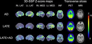 Imaging of individuals suspected of having Alzheimer.'s disease (AD), LATE, and mixed LATE and AD co-pathology