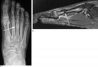 Images in a Long-Distance Runner with Left Foot Pain without a Triggering Acute Traumatic Event