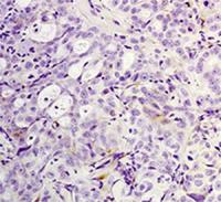 Lung Cancer Cell Resensitized