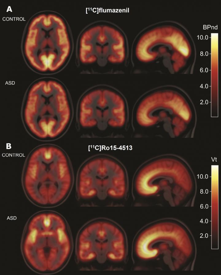 A Surprising Finding in the Brains of Autism Patients (1 of 1)
