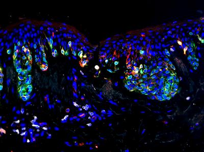 Common Moles Could Serve as Players in Battling Melanoma and Preventing Its Recurrence