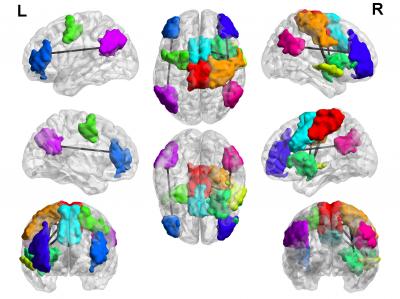 Brain Hyperconnectivity in Compulsive Video Game Players