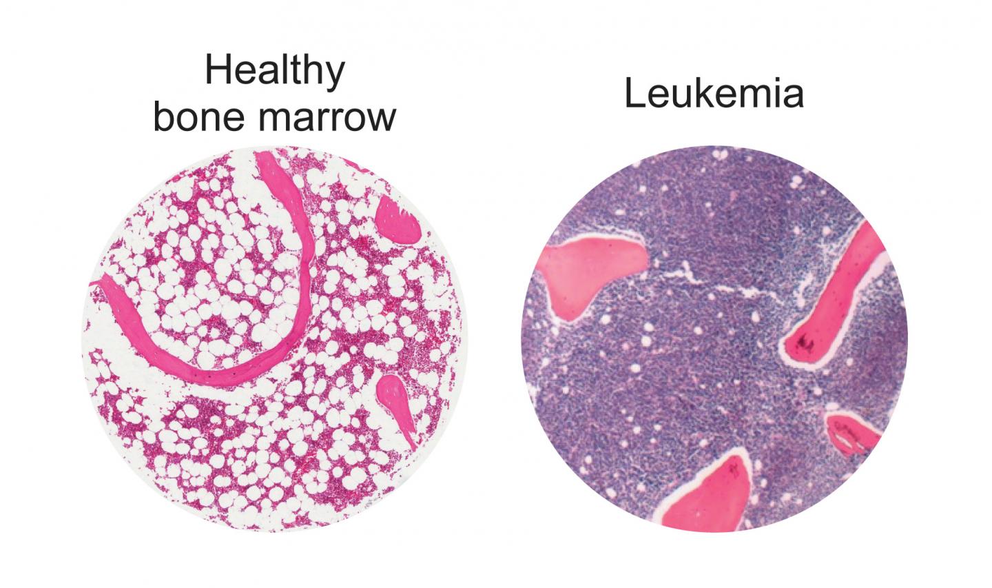 Bolstering Fat Cells Offers Potential New Leukemia Treatment: Mcmaster