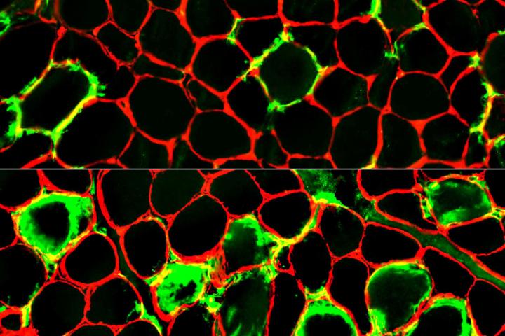 Immune Myopathy