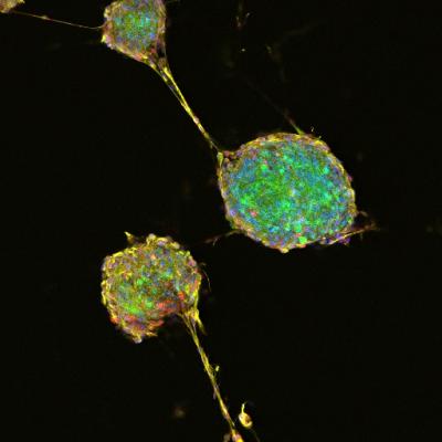 Aggressive Brain Tumors Can Originate from a Range of Nervous System Cells