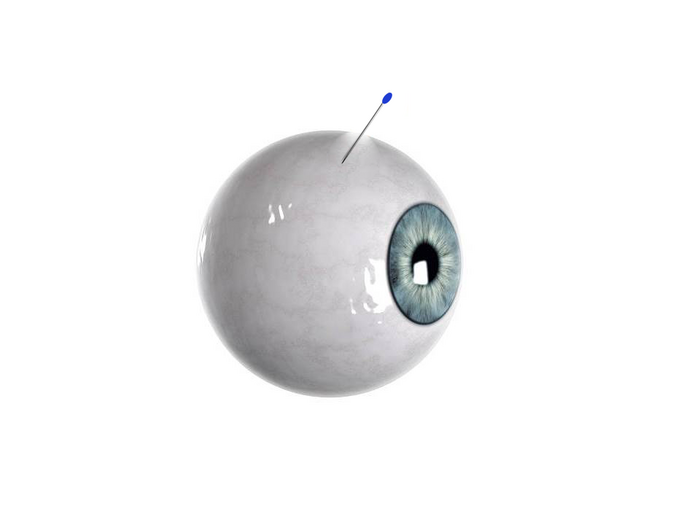 Self-Plugging Microneedle for Intravitreal Drug Delivery