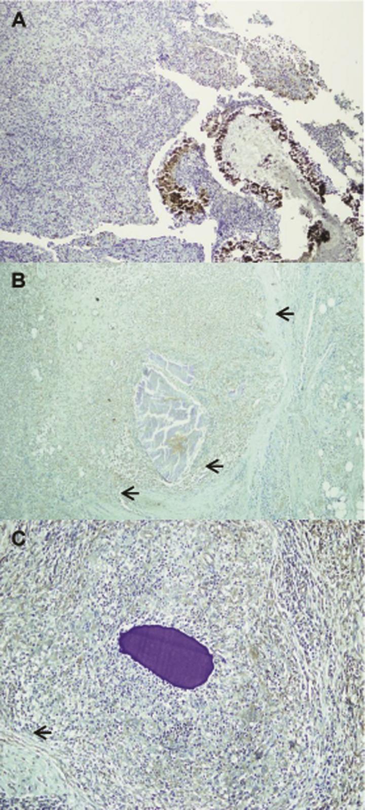 Researchers Survey Immune Molecules Found inside Mycetoma Lesions