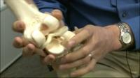 Detecting Knee-Cushion Problems Early Could Lead to Better Treatments
