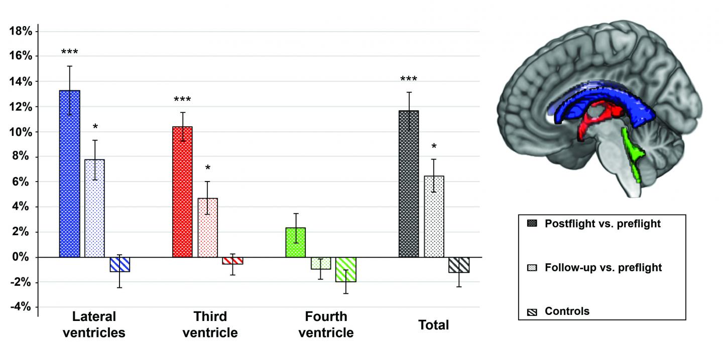 Percentage Volume Change for Each Ventricular CSF Compartment