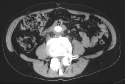 Inflammatory Tissue TC Scan