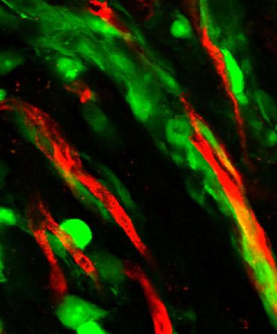 Attack of the Glioma Cells