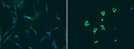 Glioblastoma