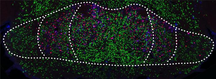 Mammillary bodies with nerve cells (green) and amyloid deposits (red/blue) characteristic of Alzheimer's disease, which impair brain function