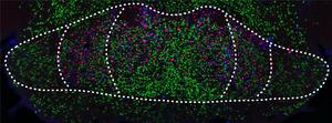 Mammillary bodies with nerve cells (green) and amyloid deposits (red/blue) characteristic of Alzheimer's disease, which impair brain function