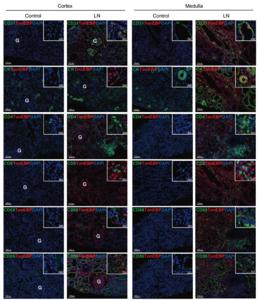 TonEBP expression in endothelial cells, epithelial cells, and infiltrating immune cells in renal biopsy tissues subjected to multiplex immune fluorescence staining.