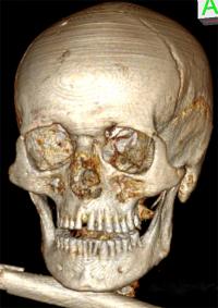 Ötzi -- the World's Oldest Wet Mummy (2 of 2)