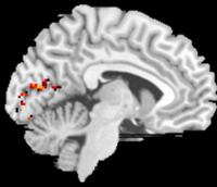 MRI of Nonpreferred Retinal Location
