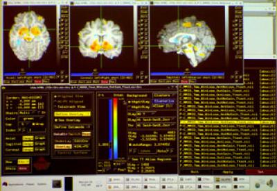 Schizophrenia and Drugs