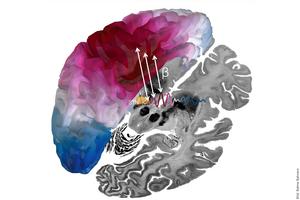 Deep Brain Stimulation