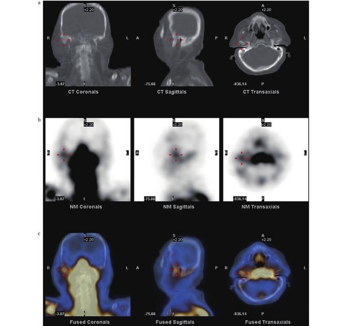 99mTc-HMPAO-labelled leukocyte scintigraphy and SPECT/CT images