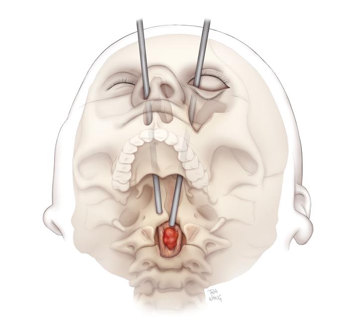 Historic Transorbital Procedure to Remove Spinal Tumor