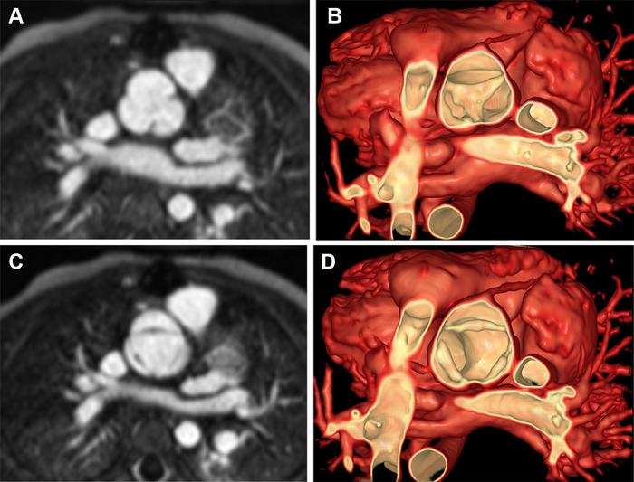 Cardiac MRI in a 4-year-old male patient with severe aortic insufficiency