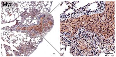 Using New Mouse Model to Find a Druggable Target in Metastatic Prostate Cancer
