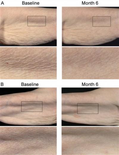 Retinol-Treated Skin