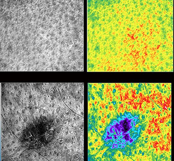 Award-Winning Tech To Improve Skin Cancer Diagnostics, Surgery