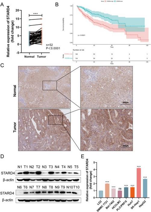 Up-regulation of STARD4 expression in hepatocellular carcinoma tissues and cells