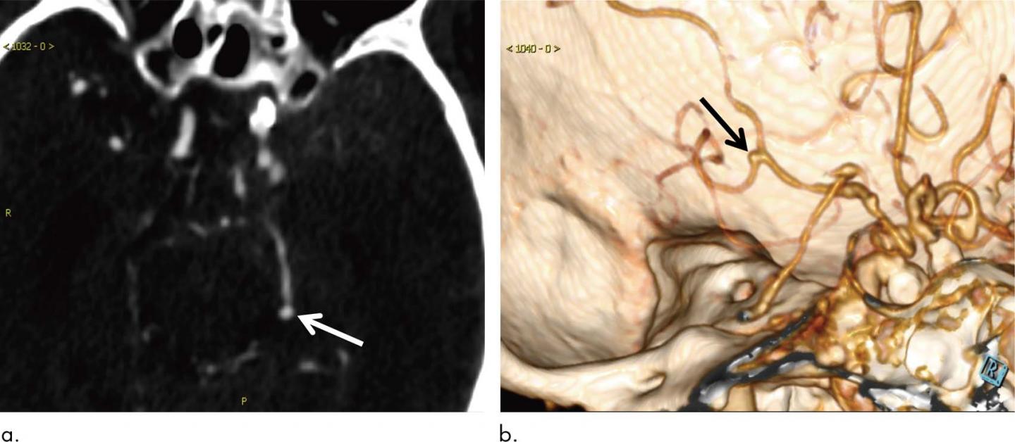 AI Helps Detect Brain Aneurysms on CT Angiography