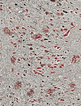 Alzheimer's Disease Plaques and Tangles