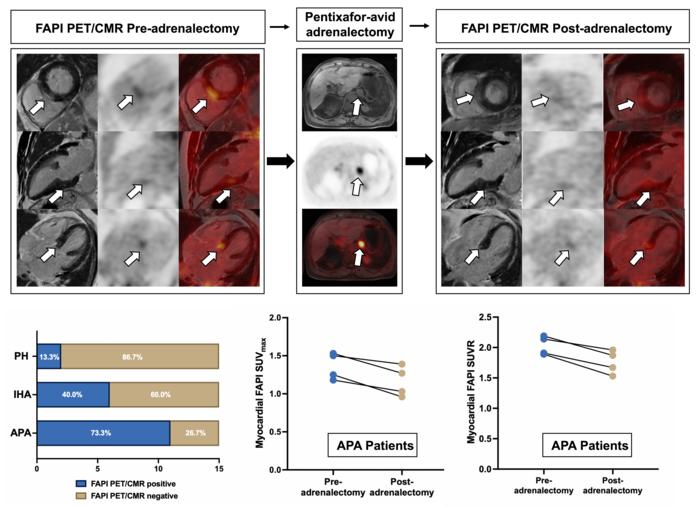 Reversible heart damage in a PA patient: Pre- vs. post-adrenalectomy 68Ga-FAPI-04 PET/CMR in an APA patient, showing decreased uptake in the basal inferoseptal segment.