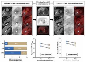 Reversible heart damage in a PA patient: Pre- vs. post-adrenalectomy 68Ga-FAPI-04 PET/CMR in an APA patient, showing decreased uptake in the basal inferoseptal segment.