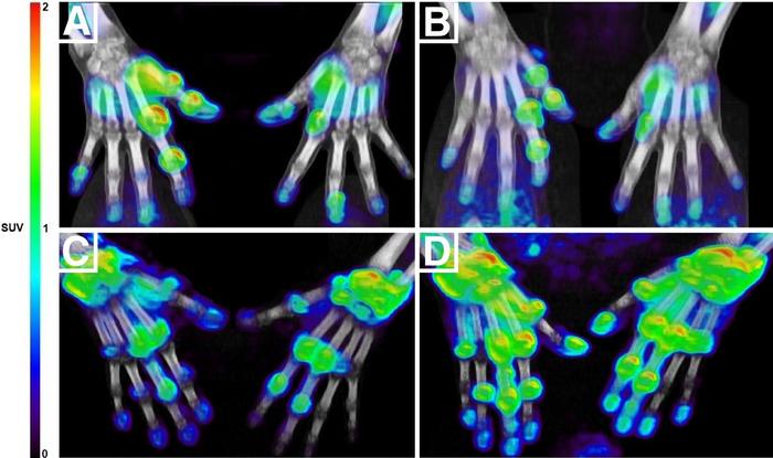 PET/CT images of hands at baseline and four weeks.