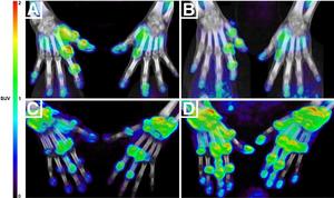 PET/CT images of hands at baseline and four weeks.