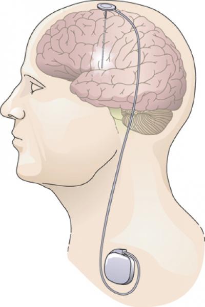 DBS for Parkinson's Disease