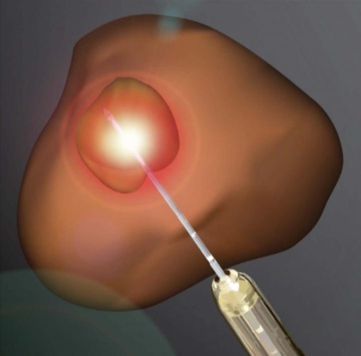 Laser Ablation