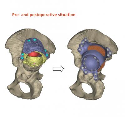 Pre and Post Op Hip