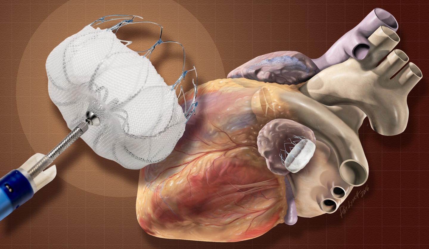 Atrial Appendage Closure Devise