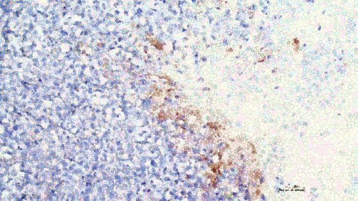 Tumor cells with CRISPR/Cas9 affected cells in brown