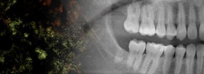 Mouth Bacteria