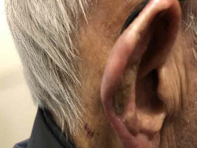 Brachytherapy Proves Effective in Treating Skin Cancer